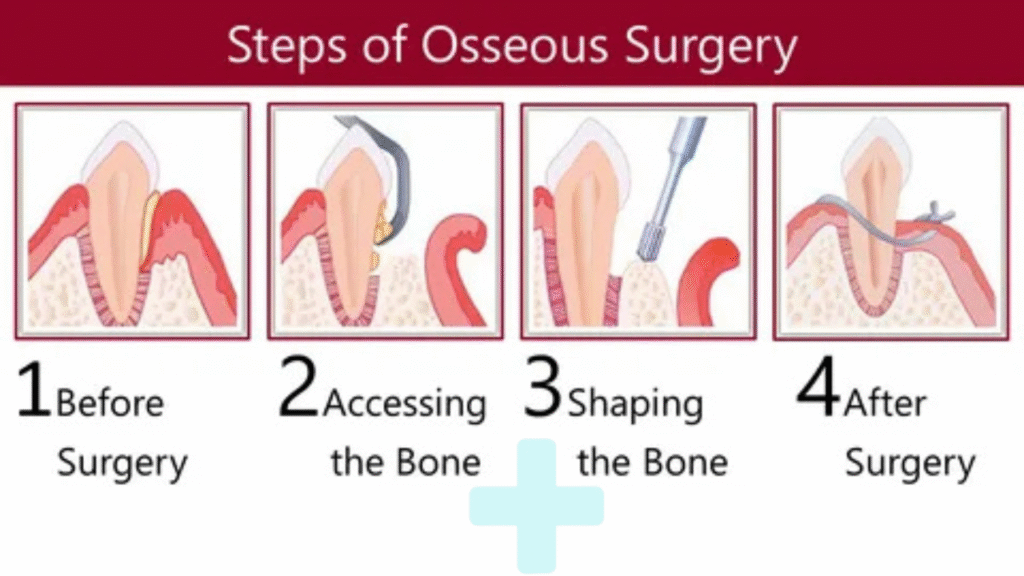 Osseous Surgery: Introduction to Restoring Gum 