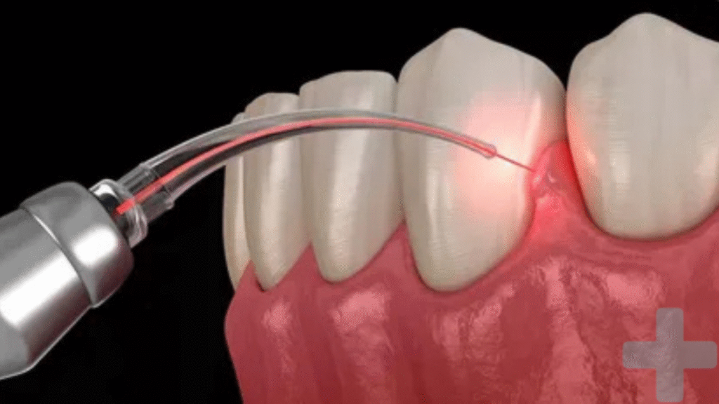 Osseous Surgery: Restoring Gum Health 