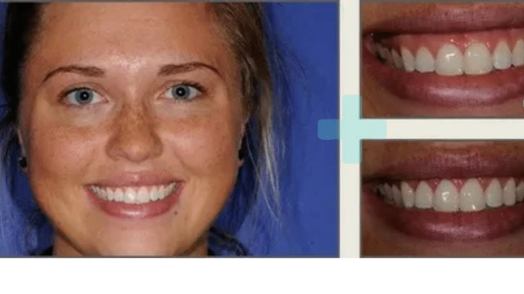 Osseous Surgery With Ultimate Price, Procedure, Recovery, and Results 2025.